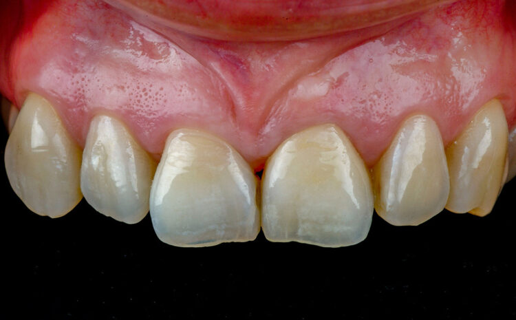 INHOUSE KURS: Zahnwerk Dreilinden Pimp my Crown – Struktur und Oberfläche mit ­Creation Magic Colour